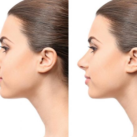 All About Rhinoplasty Surgery