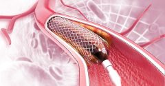 Understanding Stent Pain: Causes and Treatments